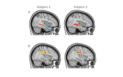 PTE阅读写作SWT训练: 大脑和语言的联系Brain & Languages